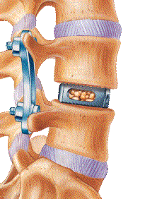 Lateral Lumbar Interbody Fusion Spine Surgery