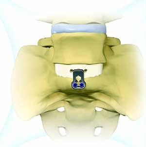 Anterior Lumbar Interbody Infusion