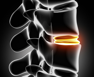 Herniated Disc Treatment Specialist in Texas