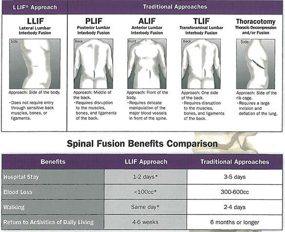 Spinal Fusion Benefits Comparison