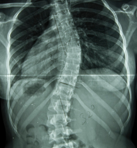 Scoliosis Treatment Texas