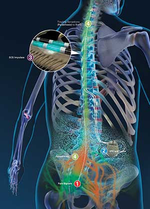 Spinal Stimulator
